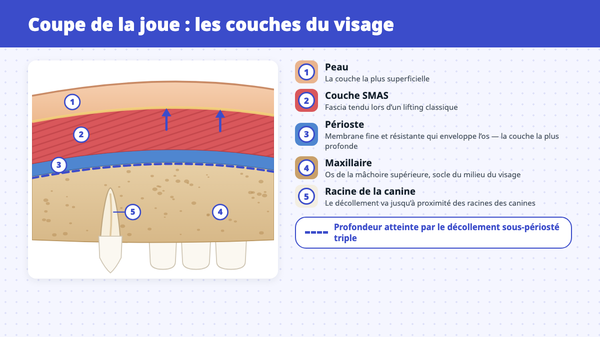 Coupe de la joue montrant la peau, la couche SMAS, le périoste, le maxillaire et la racine de la canine