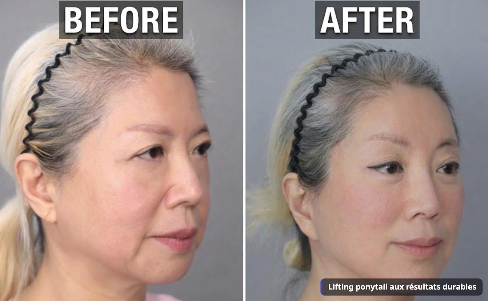 Avant et après un lifting ponytail avec décollement sous-périosté triple
